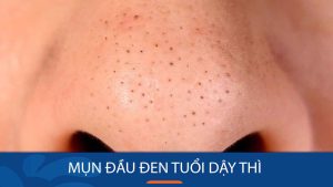 Mụn đầu đen tuổi dậy thì – Đánh bay hoàn toàn chỉ sau 7 ngày