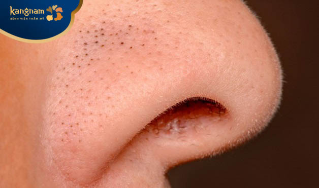 Nguyên nhân gây mụn đầu đen ở tuổi dậy thì