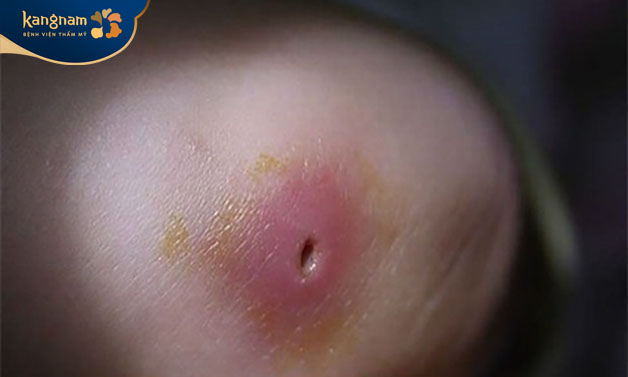 Mụn đinh râu sau khi thoát mủ sẽ để lại trên da một lỗ lõm sâu