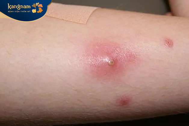 Mụn đinh râu có khả năng lây lan đến các vị trí khác trên cơ thể