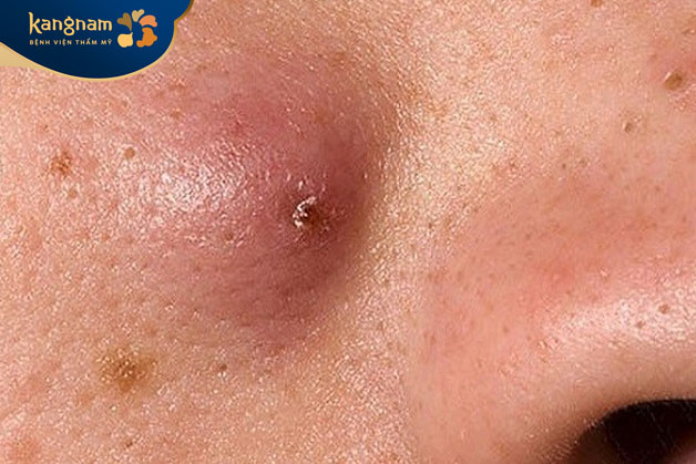 mụn đinh râu thường là dạng mụn trầm trọng hơn so với mụn trứng cá