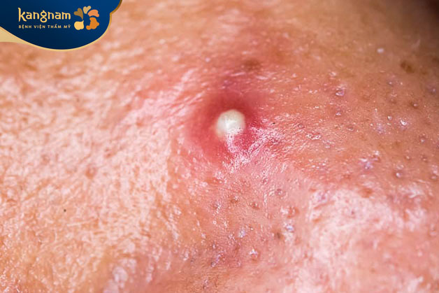 Giai đoạn 2: Mụn đinh râu hóa mủ