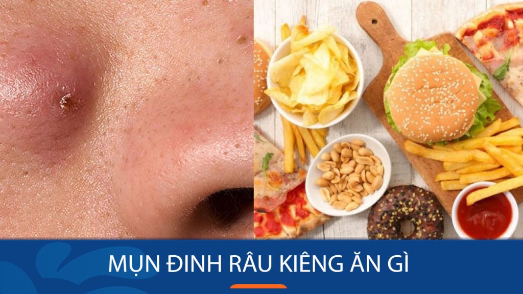 Mụn đinh râu kiêng ăn gì? Bỏ túi 4 nhóm thực phẩm “đại kỵ” để đẩy lùi mụn nhanh chóng