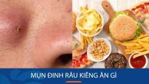 Mụn đinh râu kiêng ăn gì? Bỏ túi 4 nhóm thực phẩm “đại kỵ” để đẩy lùi mụn nhanh chóng