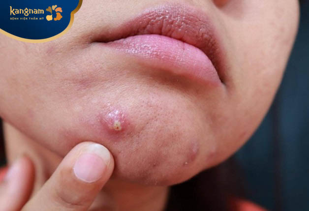 Không nên cham tay lên vùng mụn