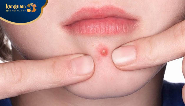 Nặn mụn bằng tay là nguyên nhân gây mụn mủ