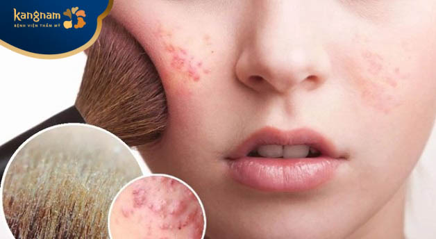 Không nên trang điểm khi da đang bị mụn