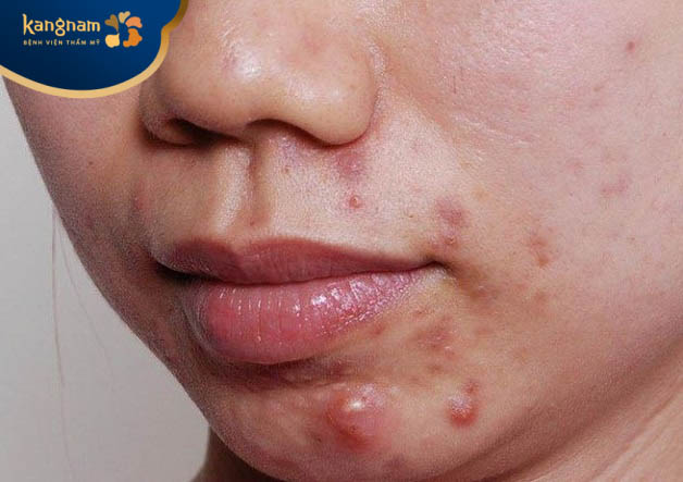 mụn mủ mọc ở cằm chủ yếu ở phụ nữ nhiều hơn so với nam giới