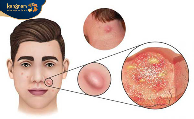 Mụn hình thành và phát triển theo 5 giai đoạn