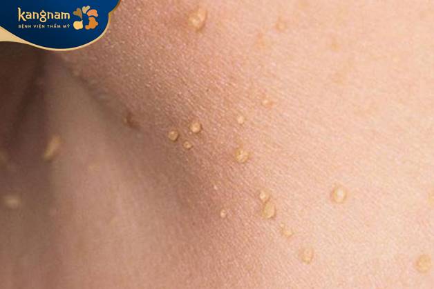 mụn thịt dư thường không gây nguy hiểm cho sức khỏe.