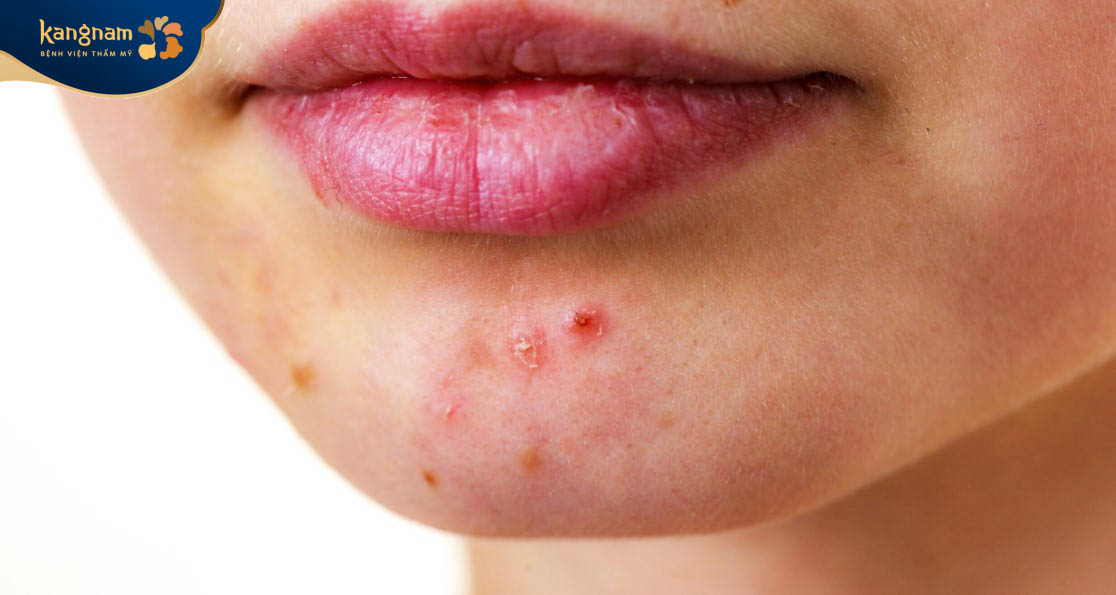 Dấu hiệu nhận biết mụn trứng cá bọc