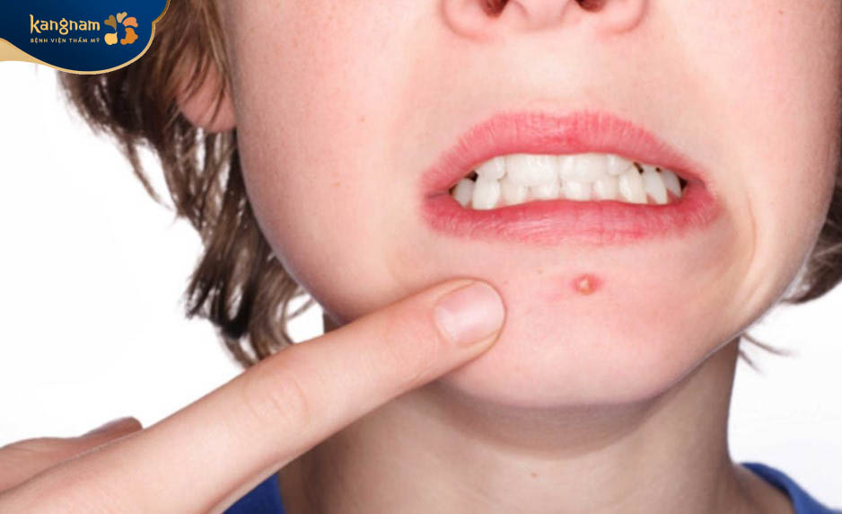 Mụn trứng cá bọc mọc ở cằm