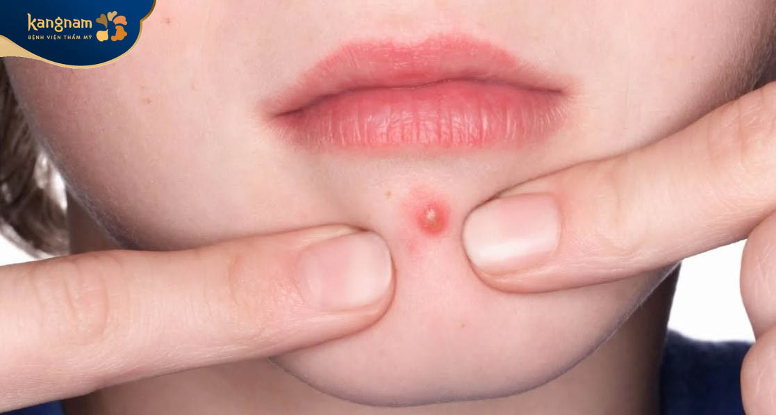 Không nên tự ý nặn mụn tại nhà