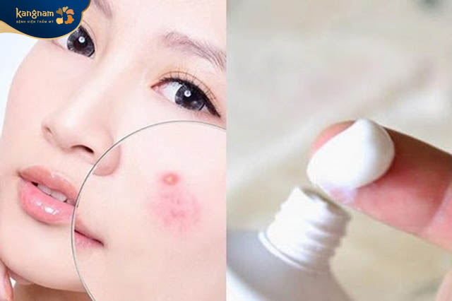 Sử dụng thuốc bôi