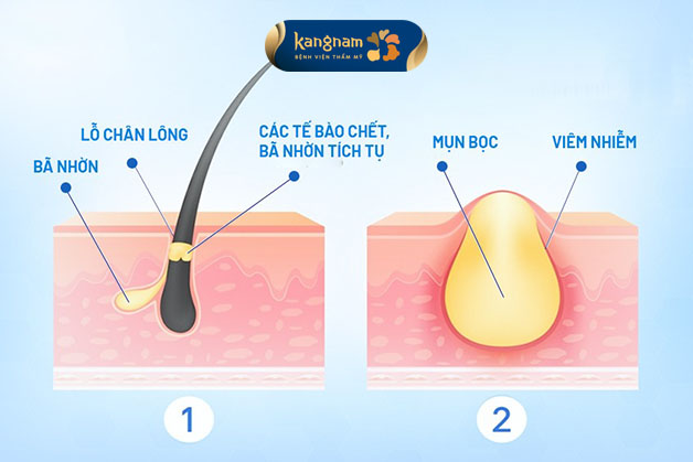 Dầu thừa, bụi bẩn tích tụ dẫn đến mụn viêm hình thành