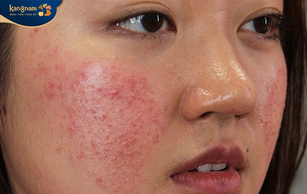 Dị ứng thời tiết khiến da nổi những đám mụn viêm li ti