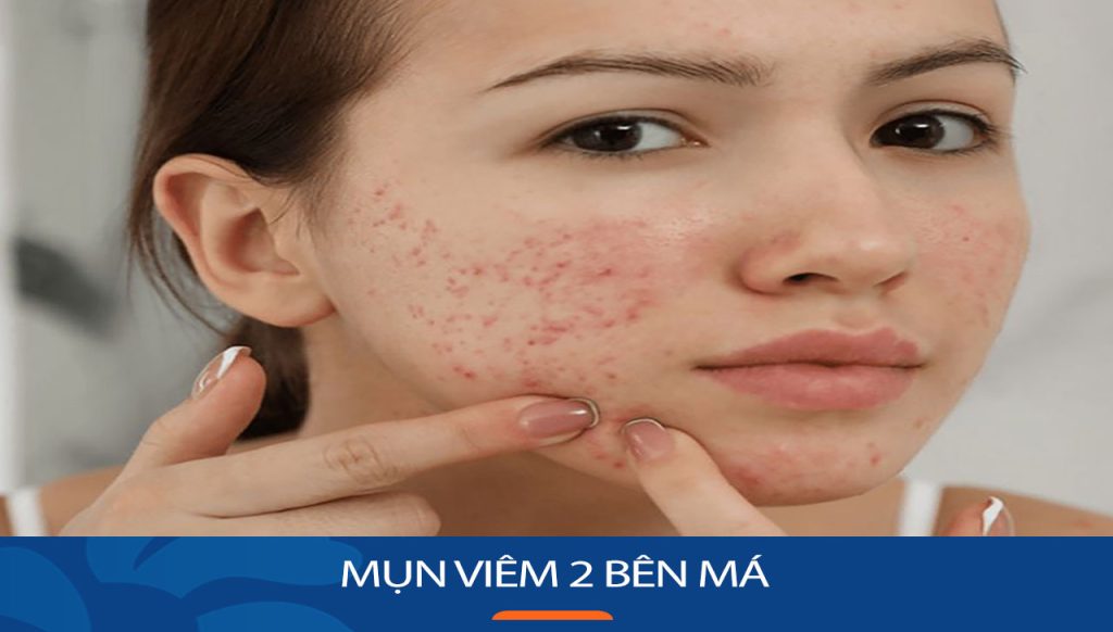 Giải cứu làn da khỏi mụn viêm 2 bên má: Hướng dẫn chi tiết từ A đến Z