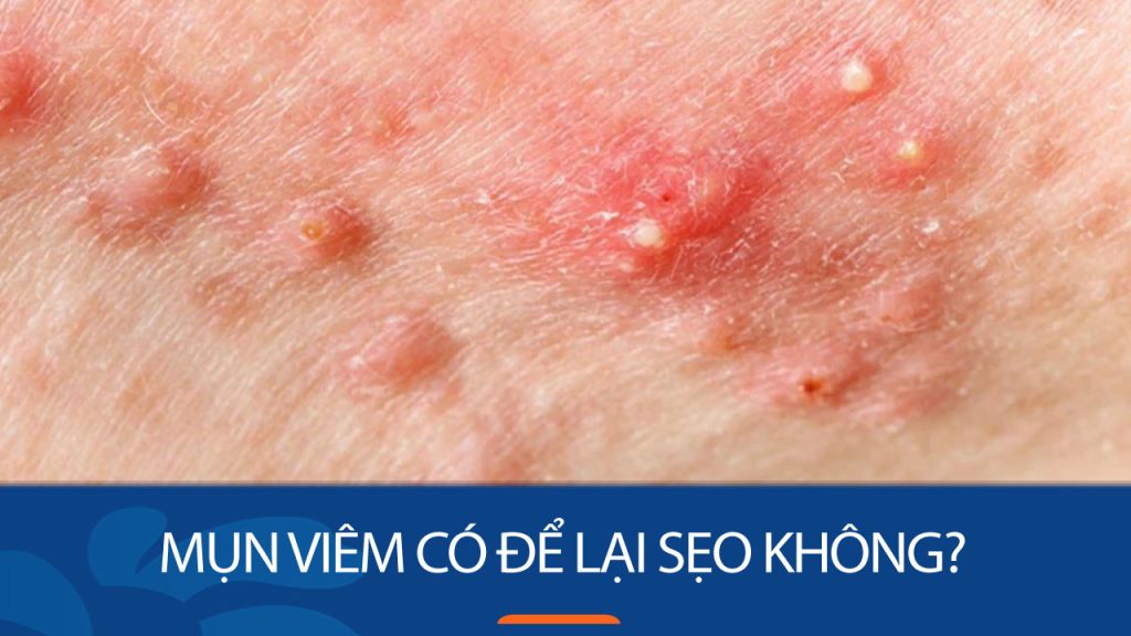 Loại bỏ sẹo mụn viêm: Bí quyết ngăn ngừa sẹo do mụn viêm hiệu quả