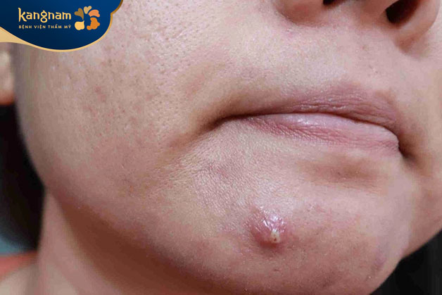 Mụn viêm có thể để lại sẹo trên da khi không được điều trị