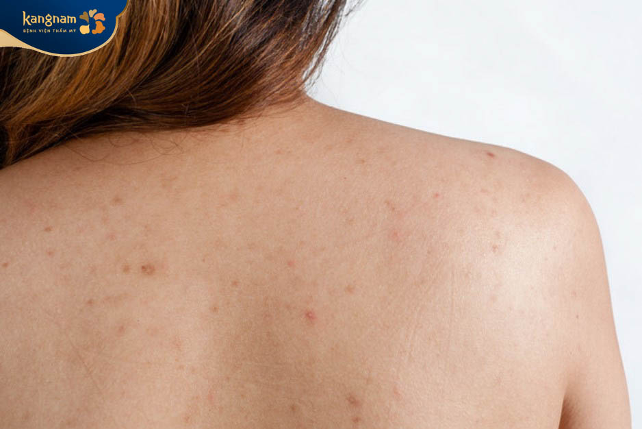 Phòng tránh mụn viêm nang lông