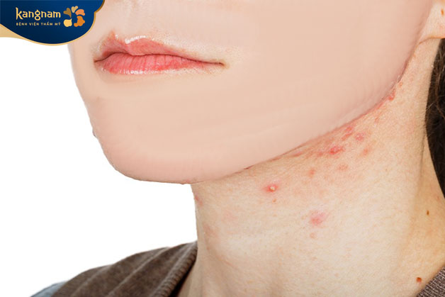 Mụn viêm mọc ở cổ do nhiều nguyên nhân khác nhau