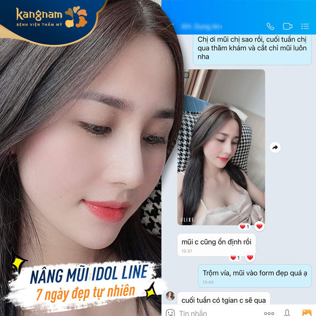 Feedback của khách hàng sau khi nâng mũi tại Kangnam