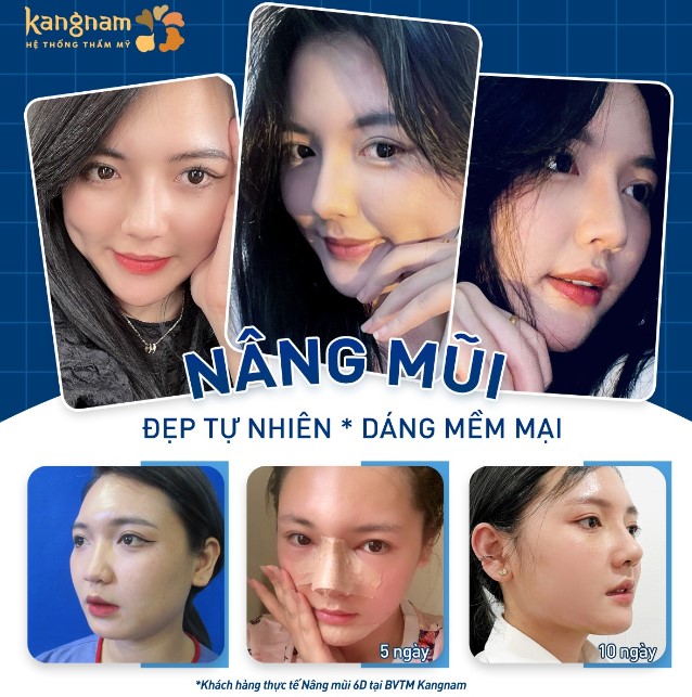 Nâng mũi 6D áp dụng kỹ thuật vô cảm, không gây đau