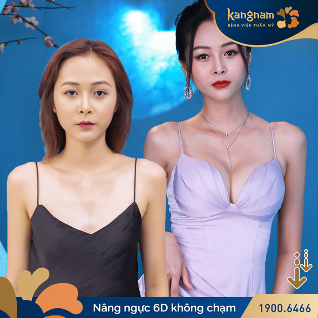 Công nghệ nâng ngực 6D không chạm