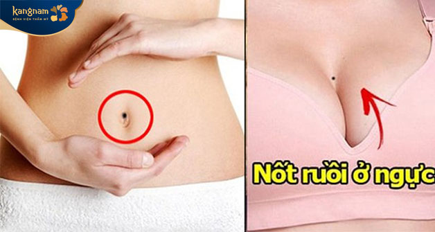 Nốt ruồi ở vị trí đặc biệt không nên xóa