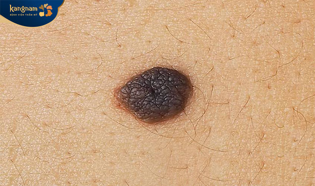 Nốt ruồi có điều khác biệt như sưng to hoặc đau đớn thì nên xóa