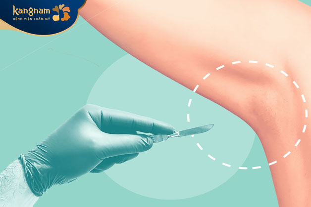 Quy trình trị hôi nách bằng công nghệ Endo Dry