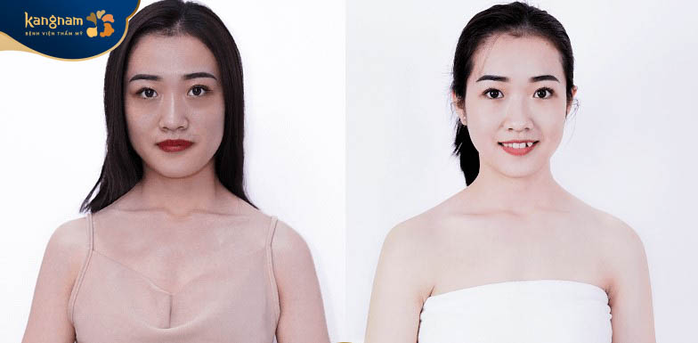 Làn da của chị khách trắng sáng bật tone rõ rệt, chỉ sau 1 buổi đầu tắm trắng phi thuyền tại Kangnam