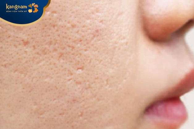 Sẹo rỗ không tự hết được