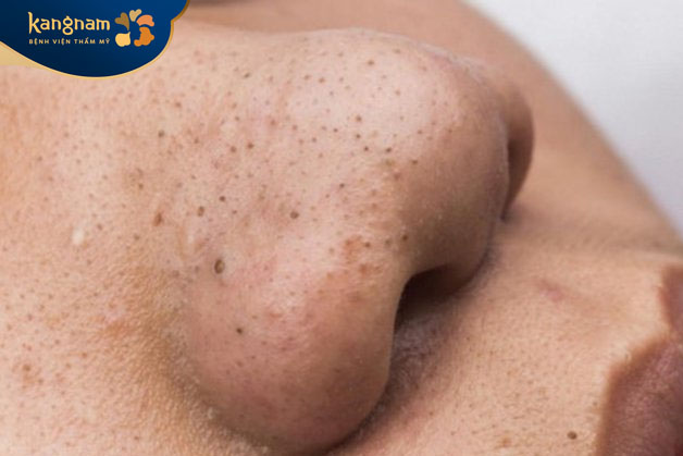 Mùi hôi từ các nốt mụn đầu đen gây ra sự khó chịu