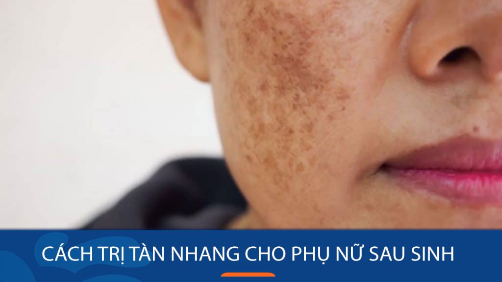 10 Cách trị tàn nhang cho phụ nữ sau sinh hiệu quả tại nhà