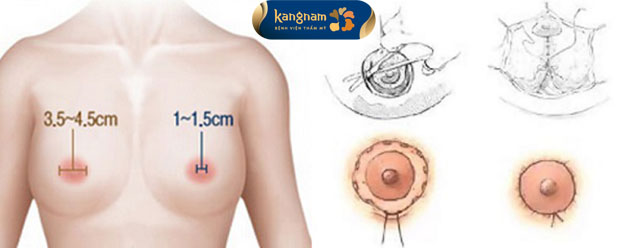 Thu nhỏ quầng vú là tiểu phẫu đơn giản nên không hề nguy hiểm đến tính mạng