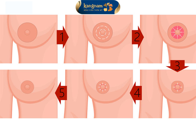 Sau khoảng 10 ngày, vết thương sẽ hồi phục