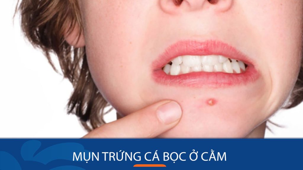 Mụn trứng cá bọc ở cằm: Bí quyết loại bỏ mụn trứng cá bọc ở cằm chỉ trong 7 ngày