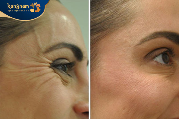 Tiêm botox cho thấy kết quả tức thì