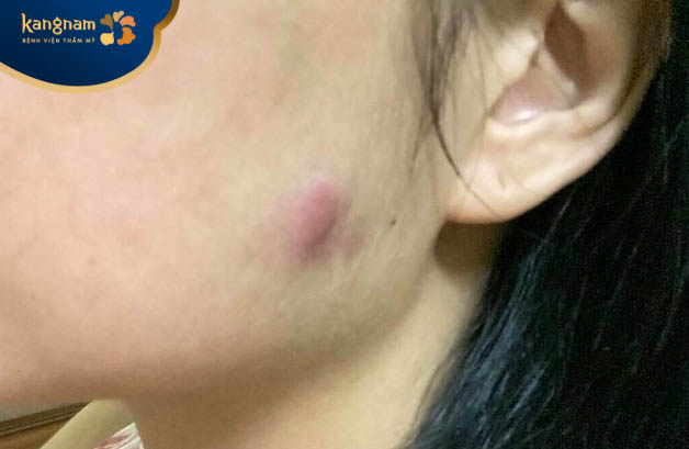 Ổ áp xe xuất hiện sau tiêm botox