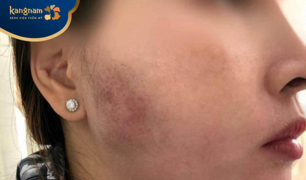 Sưng bầm da sau tiêm botox