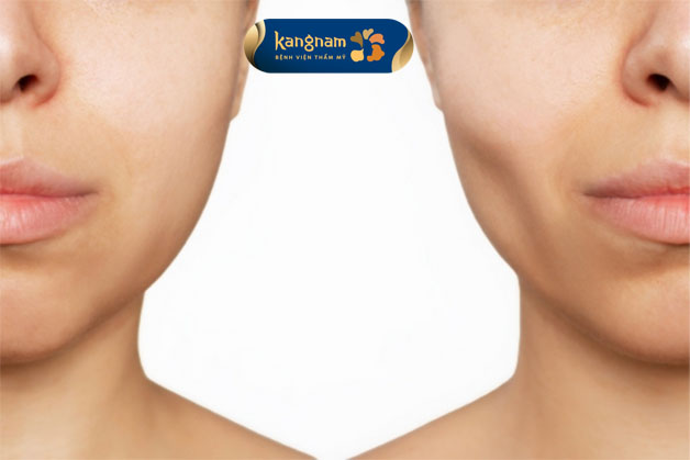 Má có thể bị hóp sau khi tiêm filler khi không đảm bảo những yêu cầu cơ bản 