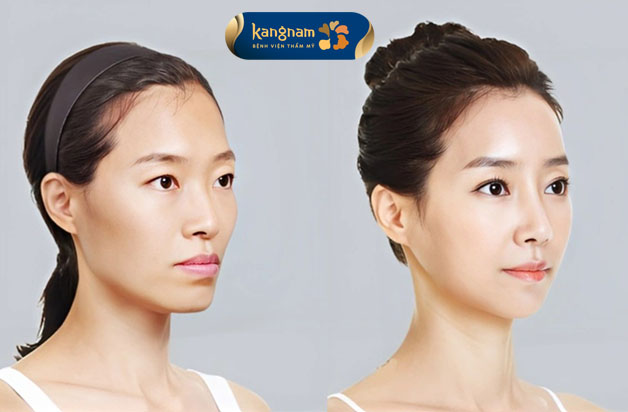Tiêm filler làm đầy má hóp là phương pháp cải thiện nhanh nhất tình trạng má hóp nặng 