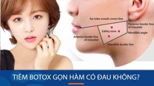 Tiêm botox gọn hàm có đau không? Giải đáp thắc mắc từ chuyên gia
