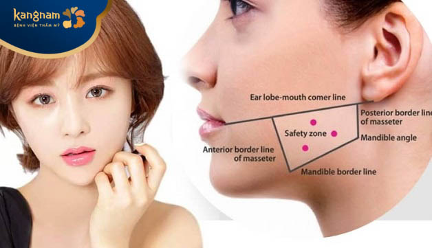 Phương pháp tiêm botox gọn hàm