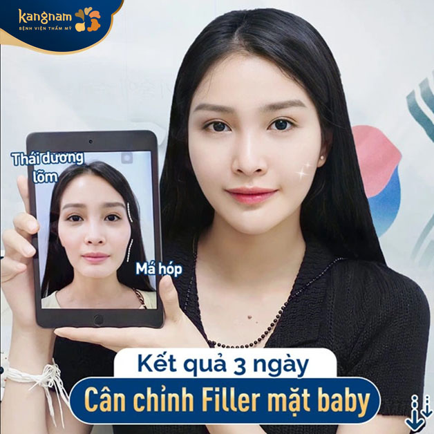 Kết quả khách hàng sau khi tiêm filler má baby tại Kangnam
