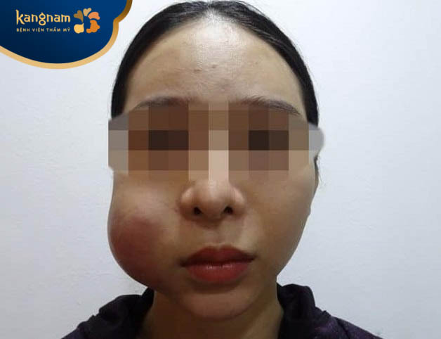 Nhiễm trùng, vón cục do chăm sóc da sai cách sau tiêm filler