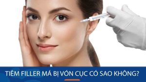 Tiêm filler má bị vón cục: Nguy hiểm không và cách khắc phục hiệu quả