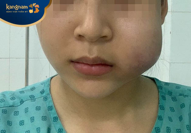 Tiêm filler má bị vón cục, sưng đỏ