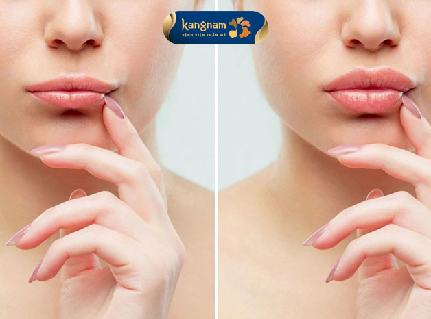 Chỉ khoảng 7 ngày sau khi tiêm môi đã ổn định và đúng form